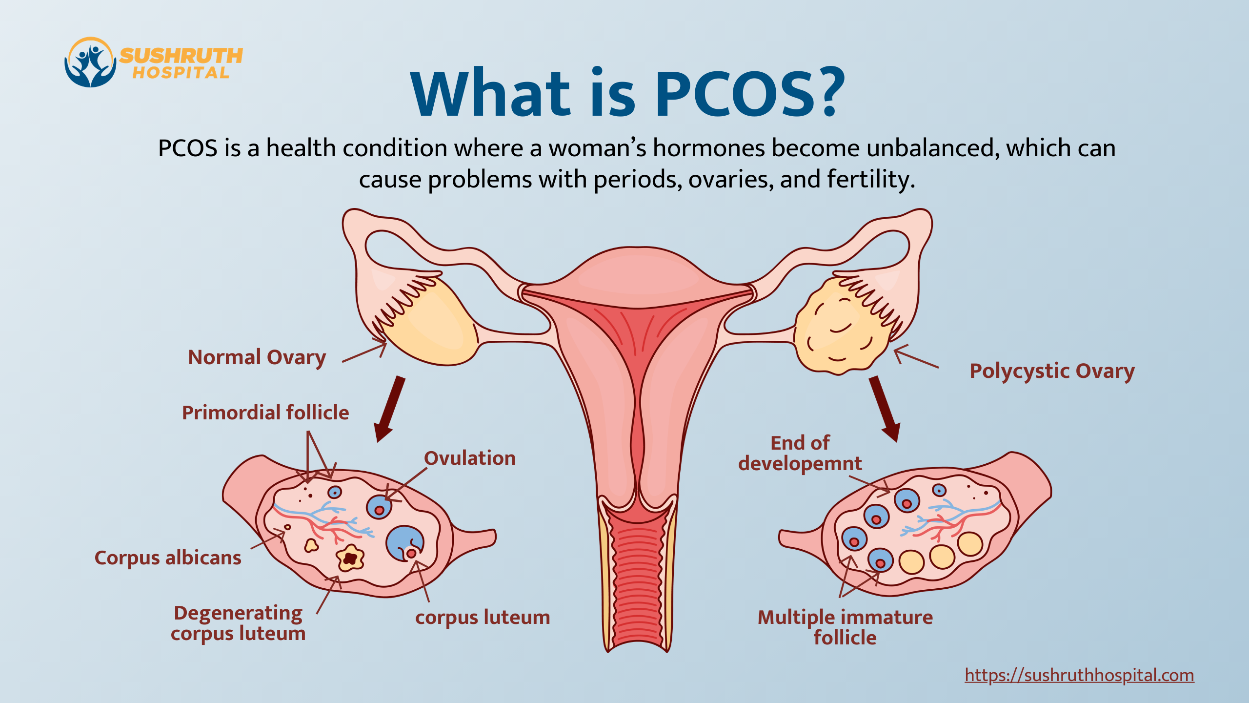 What is PCOS